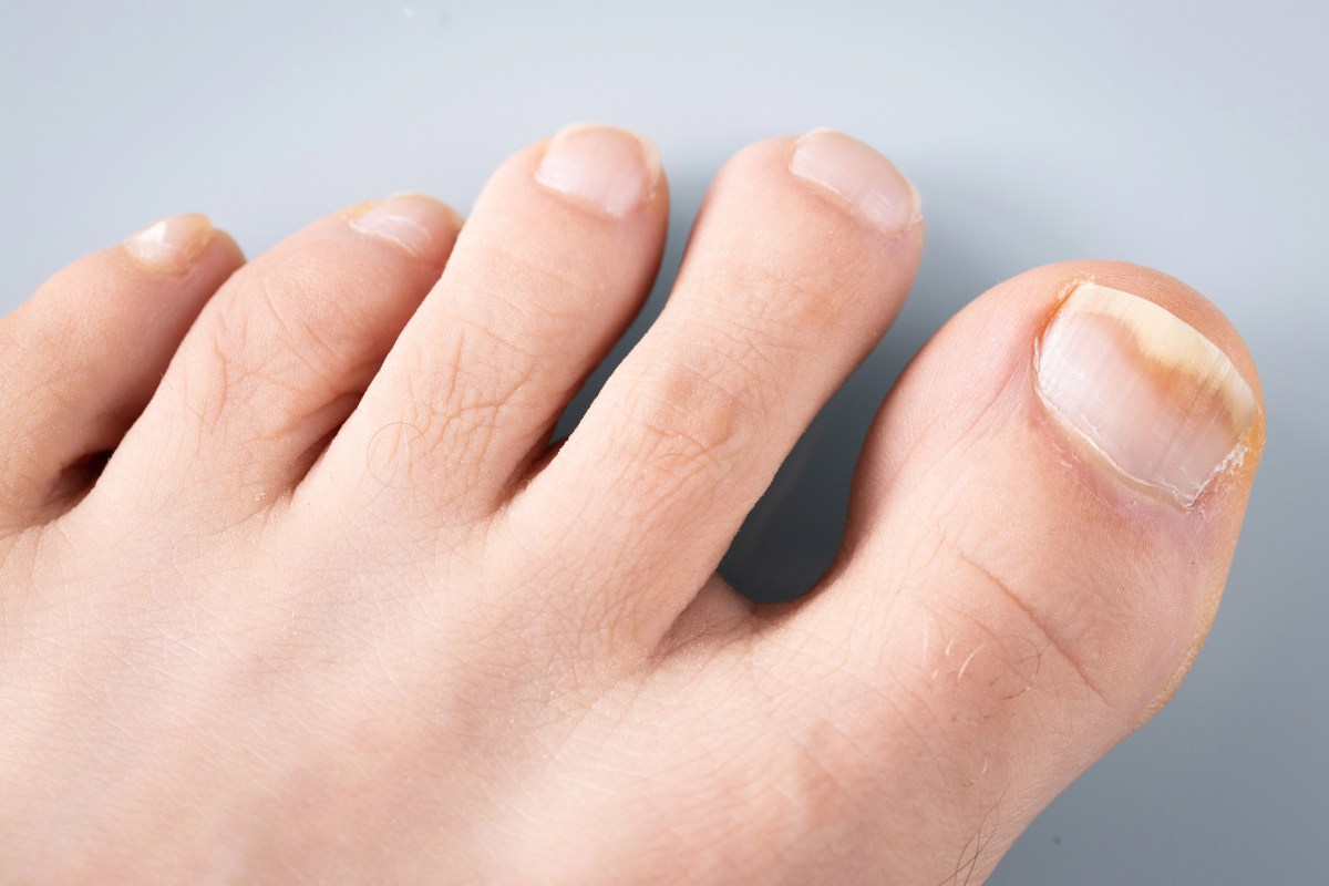 A man’s foot with fungus in the big toenail in Texas.
