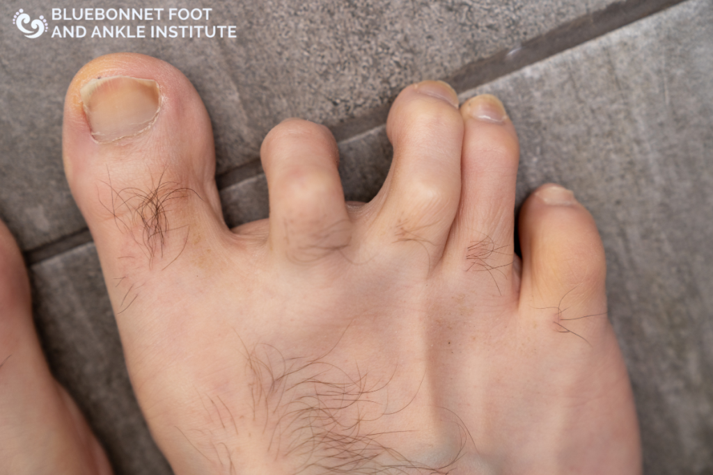 A man’s foot with hammertoes in Texas.